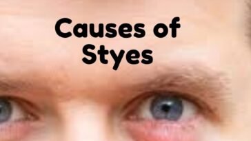 Causes of Styes