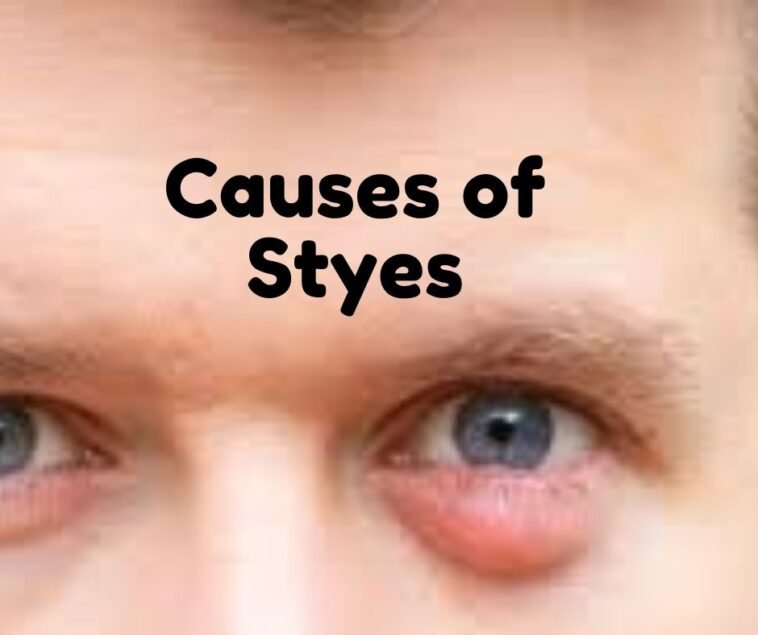 Causes of Styes
