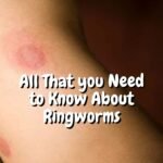 All That you Need to Know About Ringworms