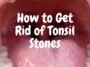 How to Get Rid of Tonsil Stones