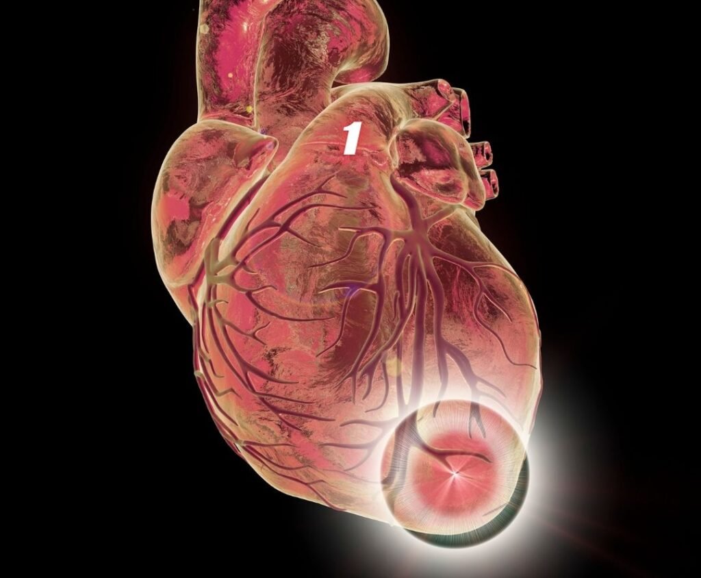 What is Acute Myocardial Infarction