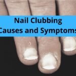 Nail Clubbing
