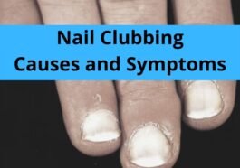 Nail Clubbing