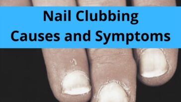 Nail Clubbing