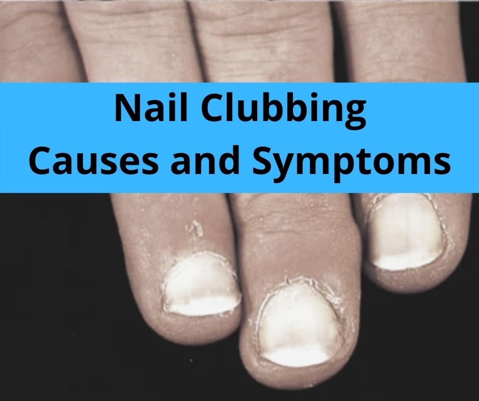 Nail Clubbing Overview Symptoms And Causes