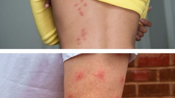 Mosquito Bites