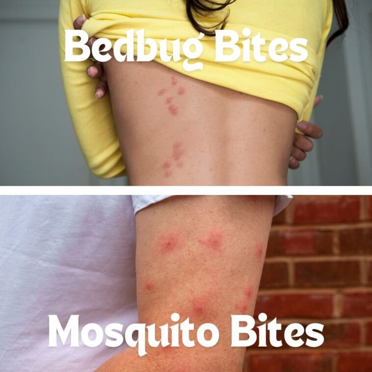 Mosquito Bites