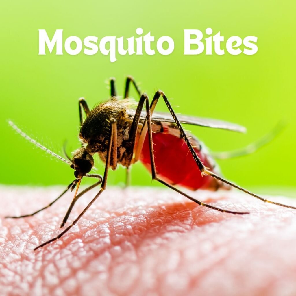 Mosquito Bites1